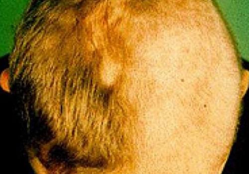 Под алопецией подразумевается полное или частичное выпадение или поредение волос, чаще на голове, реже на других частях тела