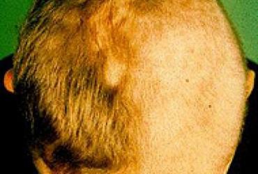 Под алопецией подразумевается полное или частичное выпадение или поредение волос, чаще на голове, реже на других частях тела